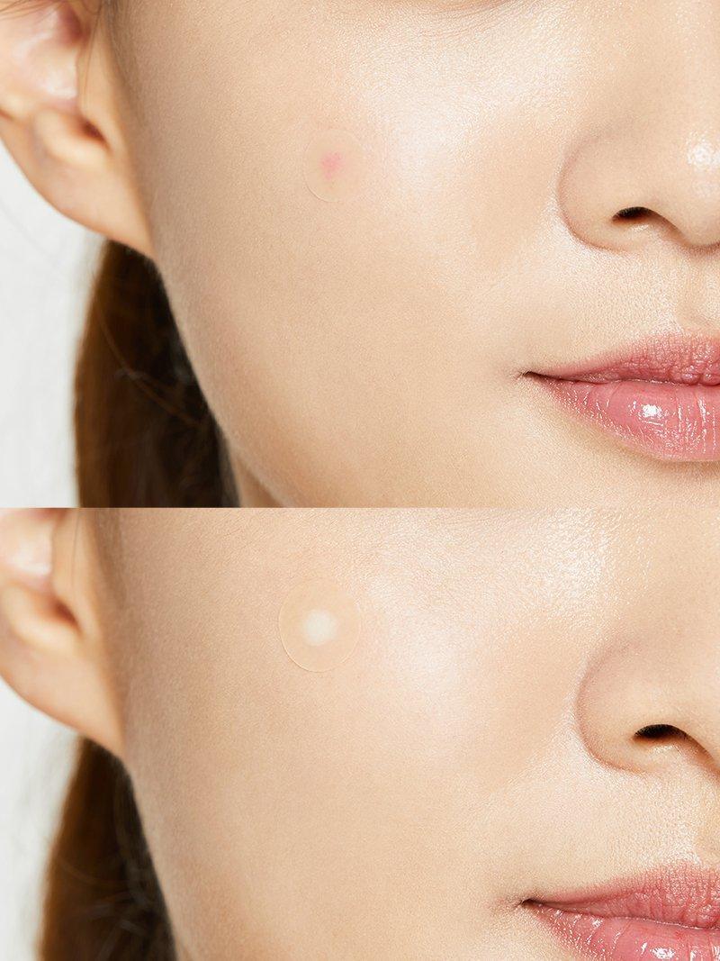 Acne Pimple Master Patch | Clear Hydrocolloid Shield